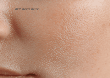 Ten după tratamentul de remodelare facială